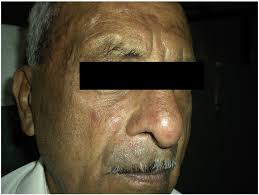 Cutaneous sarcoidosis depicting papule, nodule, and/or plaques over the... 