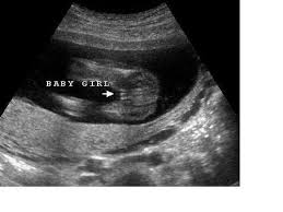 Catch A Glimpse 4d Liverpoolhow Do We Differentiate Genders On Ultrasound Catch A Glimpse