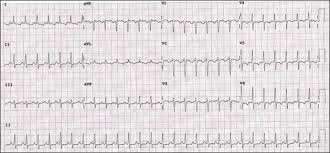 Ekg l supraventricular tachycardia (svt). 12 Lead Surface Ecg Showing Svt Consistent With Atrial Tachycardia Download Scientific Diagram