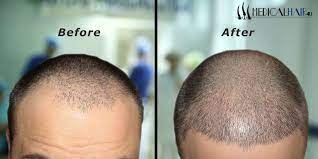 Tracking Costs For A Hair Transplant Surgery Talk To One Of The Experts At Medicalhair4u Com And Discover A In 2021 Hair Transplant Hair Transplant Cost Hair Implants