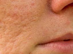 We did not find results for: Sulfur For Acne Uses For Different Types