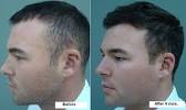 One Month Hair Growth Men