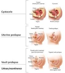Types Of Pelvic Organ Prolapse Macobgyn Urogyn Prolapse Bladder Prolapse Uterine Prolapse Pelvic Organ Prolapse