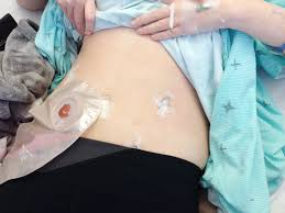 Hospital Recovery Colectomy Ostomy Bag Stoma