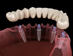 We did not find results for: What Are All On 4 Dental Implants Magic Smile Turkey