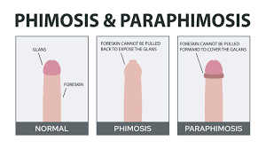Image result for Phimosis