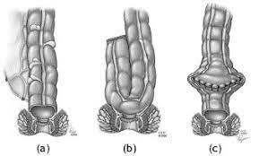 Intestinal anastomotic dehiscence (iad) is one of the severe complications in colorectal surgery that is. Radiological Appearances In The Pelvis Following Rectal Cancer Surgery Clinical Radiology