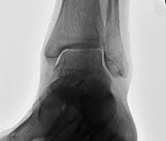 Also the deltoid ligaments are strong and often an avulsion fracture at the medial malleolus occurs before a deltoid ligament sprain. Broken Ankle Or A Sprain How Do You Know Beacon Orthopaedics Sports Medicine