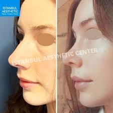 Istanbul aesthetics and medical surgery center is a plastic surgery hospital established to render good services for you with high technology devices and . Before After Rhinoplasty Istanbul Aesthetic Center Facebook