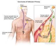Image result for icd 10 code for cancer of unknown primary