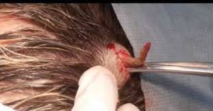 Not only do they cause bumps. Infected Ingrown Hair On Head Ingrown Hair