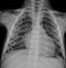 Imaging Findings Of Metabolic Bone Disease Radiographics