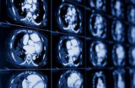 There are a few kinds of ct machines, but in general, they are large machines with a short. Ct Scans And Cancer What Are The Risks Chris Kresser