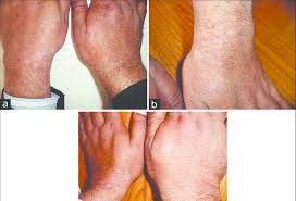 These yeasts are normally found on the human skin and become troublesome only under certain circumstances, such as a warm and humid environment, alt. A C Acral Pityriasis Versicolor Multiple Scaly Hypopigmented Download Scientific Diagram