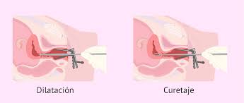 El legrado endocervical consiste en insertar un instrumento pequeño y afilado con forma de pala (cureta o legra) en el conducto a través del cuello del útero (canal cervical). Legrado Uterino Procedimiento Recuperacion Y Complicaciones