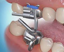 There are many different mandibular anterior repositioning appliances (mara) available on the market. What Is The Mara Appliance Affordable Braces Jorgensen Orthodontics