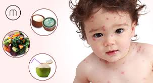 7 effective fruitful diet for chickenpox patient