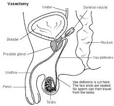Image result for Vasectomy