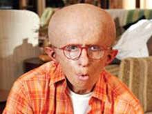 Image result for progeria case in bihar