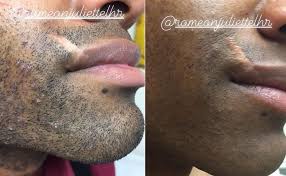 Again, exfoliating gets rid of dead skin cells, making it harder for hairs to get trapped under the skin. Ingrown Hair Removal Nyc Ingrown Laser Hair Treatment Manhattan Ny