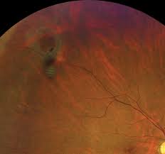 Rhegmatogenous retinal detachments are often due to retinal tears associated with posterior patients who present with symptoms of new onset significant photopsias and/or persistent new. Can We Pre Empt Damage From Retinal Detachment