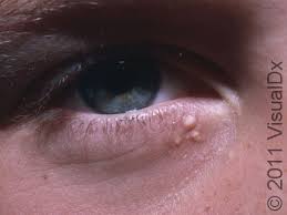 Image result for milium cyst on eyelid