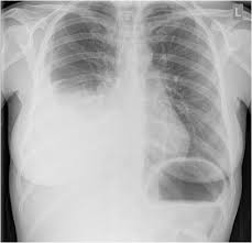 Image result for Pleural Tuberculosis