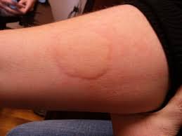 For 2 Years I Suffered From A Beef Allergies Every Time I Ate Beef I Would Get Hives My Tongue Would Sw Urticaria Chronic Hives Chronic Idiopathic Urticaria