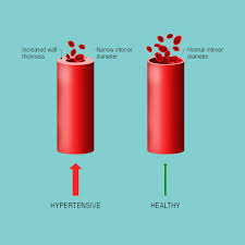 Image result for Hypertension