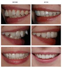 Inman aligner is suitable for older teenagers and adults that have mild to moderate protrusion or crowding in their front teeth. Inman Aligner Before And After Pictures Inman Aligner