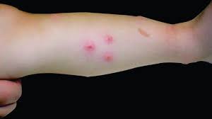Image result for Papular urticaria