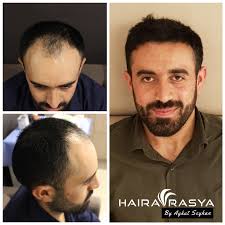 Revitalize Your Hair With Hairavrasya Whatsapp 90 542 357 2885 Sacekimi Sacekimiistanbul Transplan
