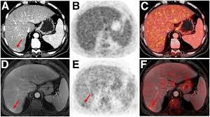 It also can let you and your doctors know if cancer treatment is working. Pet Mri Improves Lesion Detection Reduces Radiation Exposure Eurekalert Science News
