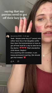 Understanding Cystic Acne: Rylie’s Skincare Journey