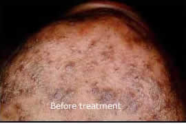 Picking and squeezing are of no use as you have probably seen it already. Laser Ingrown Hair Beard Razor Bump Removal New York City Manhattan