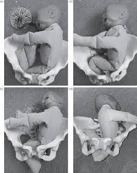 Image result for Breech Delivery