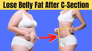How To Lose Hanging Belly Fat After C-Section Naturally | Get Rid Of Tummy  Fat After Caesarean - Youtube