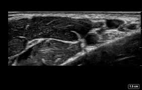 Image result for Axillary Nerve Block