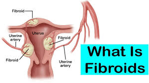 Ini merupakan gejala mental yang membuat pengidapnya mengalami kebingungan berat dan kesadaran yang berkurang akibat. Ciklilyputih The Lifestyle Blogger My Fibroid Journey Tanda Tanda Fibroid Muncul