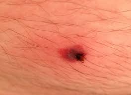 Tick Buried Under My Skin Gross German Shepherd Dog Forums Tick Removal Ticks Remove Ticks From Humans