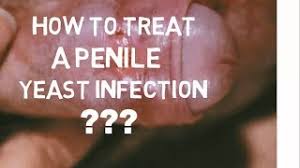 Ketoconazole cream official prescribing information for healthcare professionals. How To Treat A Penile Yeast Infection 11 Steps With Pictures