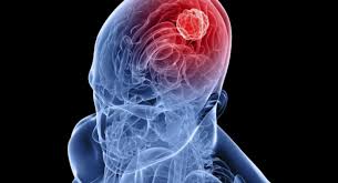 Beyinde Pihti Atmasi Nedir Tedavisi Nelerdir