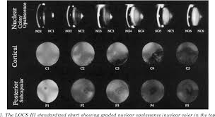 Figure 1 From Clinical Importance Of The Lens Opacities