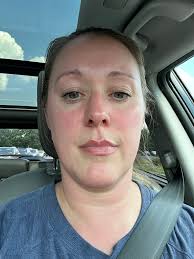 Can touching shingles sores trigger chicken pox in someone with LCH?