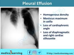 Pleural Effusion In 2020 Pleural Effusion Pathology Interpretation