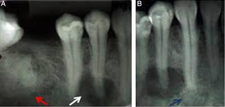Radiographically it passes through the three phases(osteolytic stage, intermediate stage. Florid Cemento Osseous Dysplasia A Case Of Misdiagnosis Journal Of Endodontics