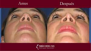 Galería Rinoplastia