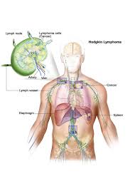 Image result for Lymphoma