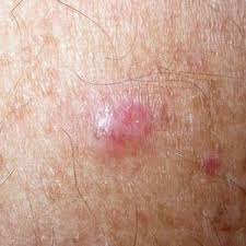 01.07.2016 · hoffa's disease affects mostly young women. Do You Know Skin Cancer When You See It Skin Repair