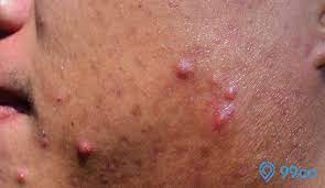 Oleh sebab itu, membersihkan wajah anda secara benar dan teratur adalah cara menghilangkan bruntusan yang efektif. 16 Cara Menghilangkan Jerawat Batu Di Wajah Cepat Efektif